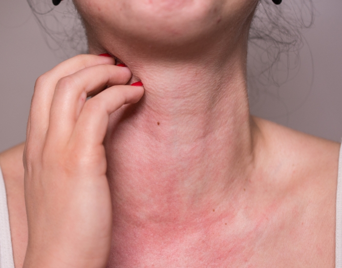 Severe Allergic Reaction Symptoms: When It Becomes a Medical Emergency