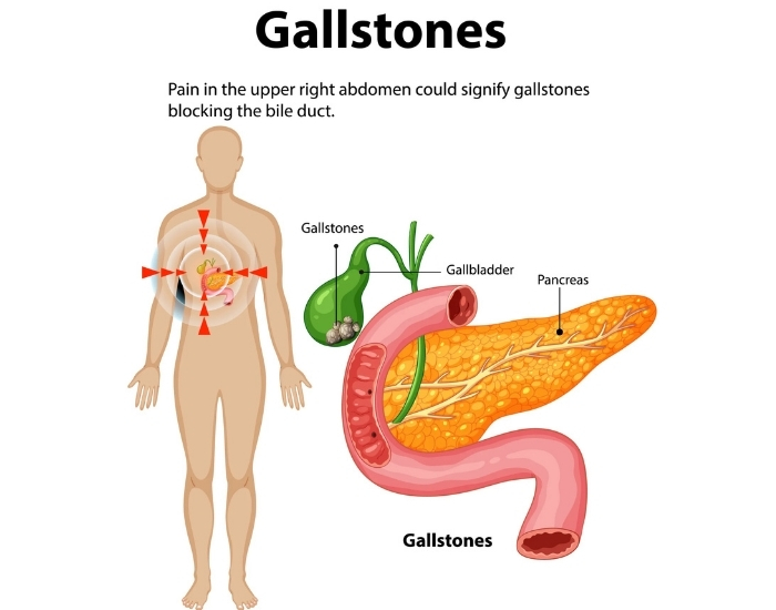 Discover gallbladder attack symptoms, causes, and when upper right abdominal pain requires emergency evaluation and treatment.
