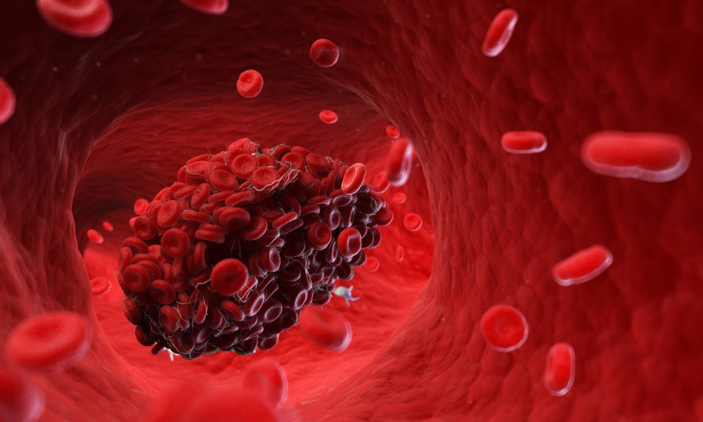 Deep vein thrombosis showing leg swelling redness warmth and pain symptoms of blood clot