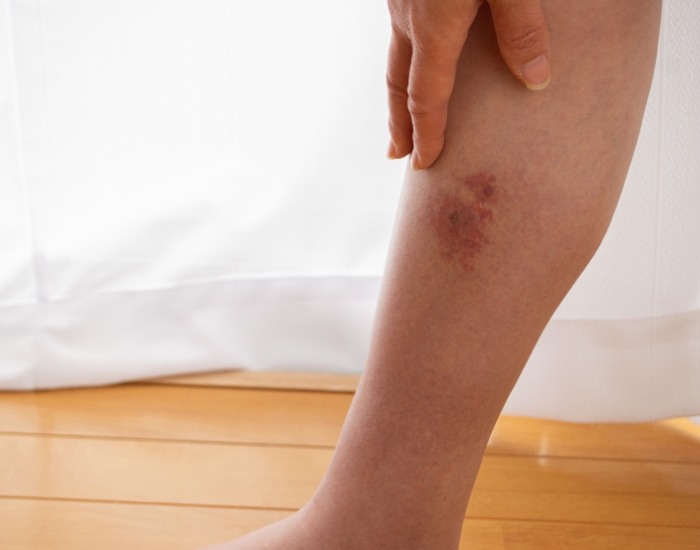 when should I go to the ER for cellulitis