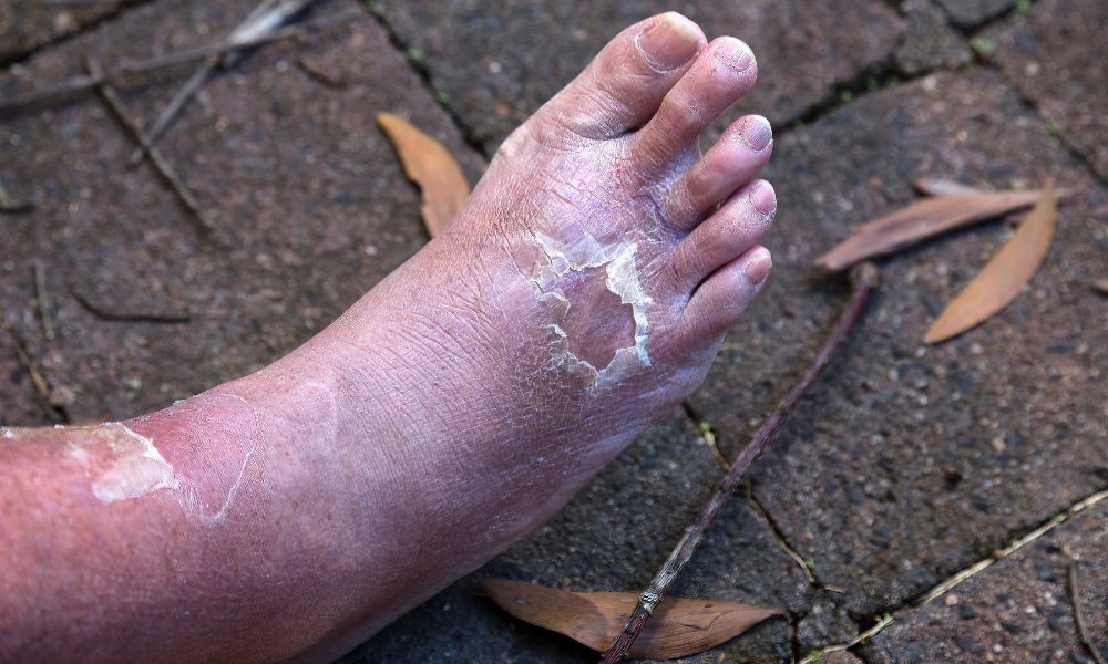 What does cellulitis look like on the skin with redness swelling and inflammation