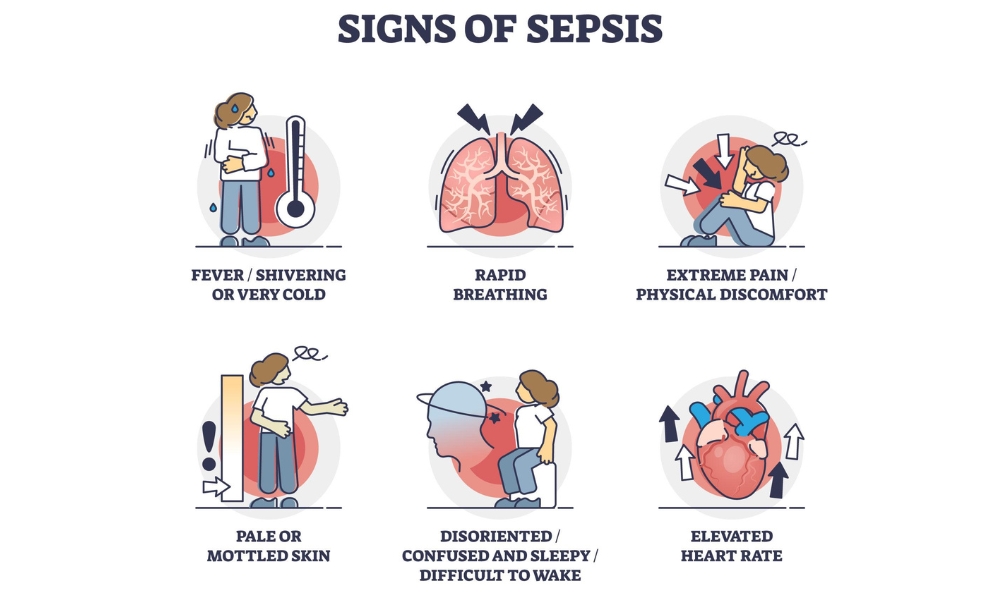 What does sepsis feel like symptoms including fever weakness confusion and infection