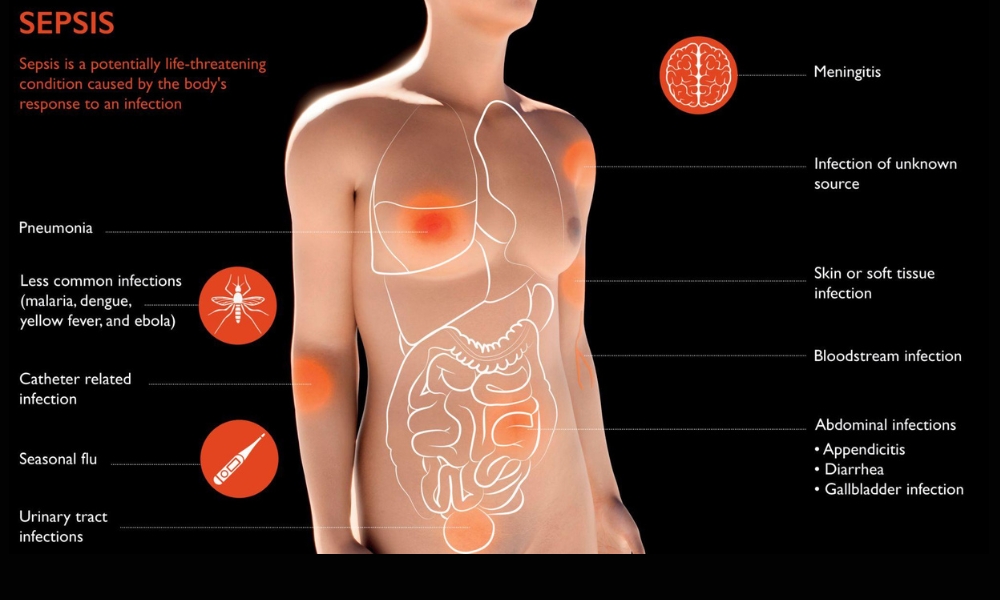 Early warning signs of sepsis including fever confusion weakness and rapid breathing