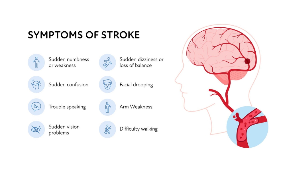 FAST stroke warning signs showing face drooping arm weakness and speech difficulty
