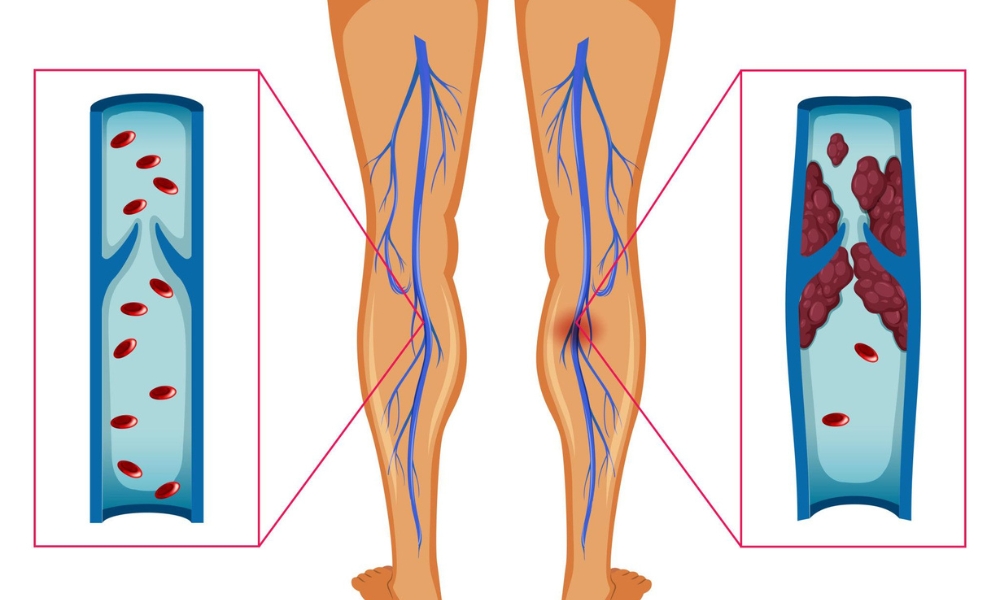 Blood clot symptoms in leg showing swelling redness and pain from DVT
