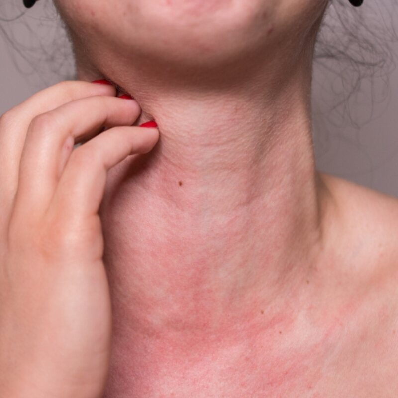 Allergic reaction and anaphylaxis care at The Heights Emergency Room in Houston