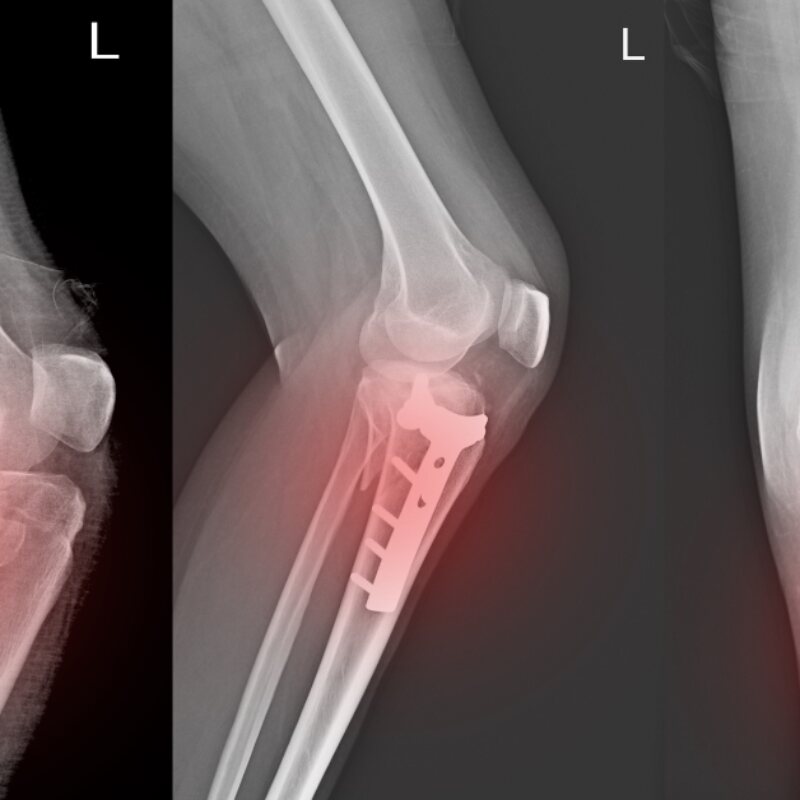 Broken bone and fracture evaluation with X-ray at The Heights Emergency Room in Houston