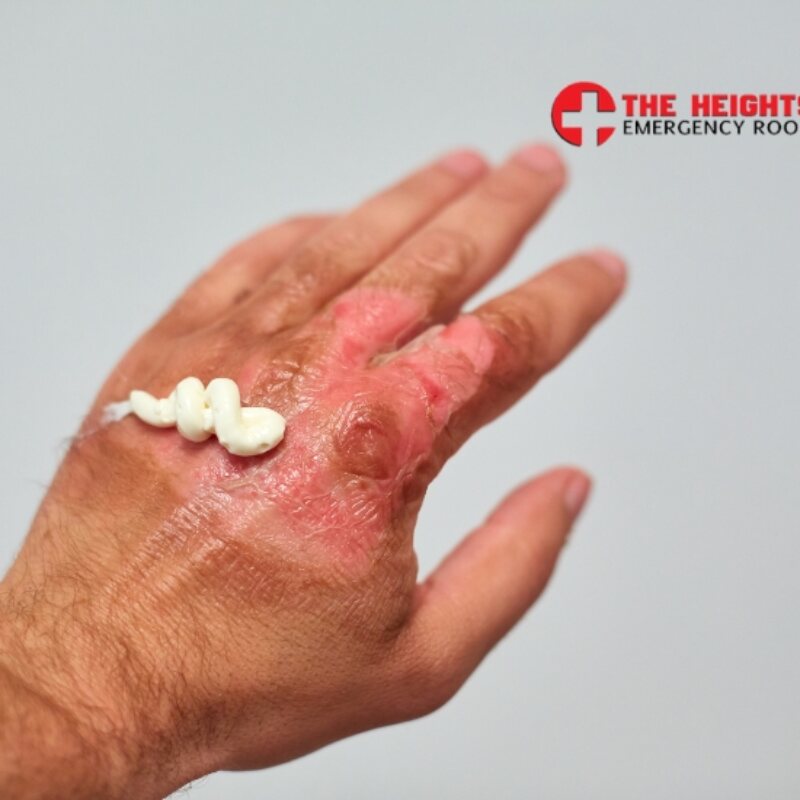 Burn injury evaluation at The Heights Emergency Room in Houston