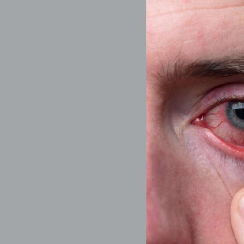 Pink eye evaluation at The Heights Emergency Room in Houston